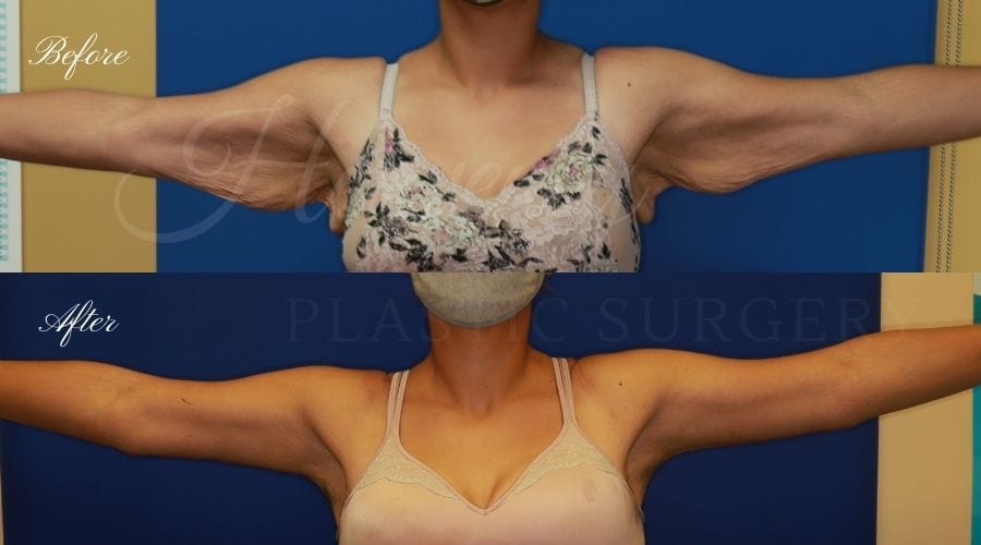 Plastic Surgery, plastic surgeon, mommy makeover, arm lift, abdominoplasty, brachioplasty, extra skin Plastic Surgery, plastic surgeon, mommy makeover, arm lift, abdominoplasty, brachioplasty, extra skin