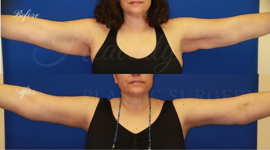 arm lift, extra arm skin, flabby arms, brachioplasty, before and after arm lift, plastic surgery, plastic surgeon, arm lift specialist, arm lift expert