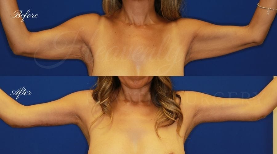 Plastic Surgery, plastic surgeon, arm lift, brachioplasty, back lift, upper body lift Plastic Surgery, plastic surgeon, arm lift, brachioplasty, back lift, upper body lift