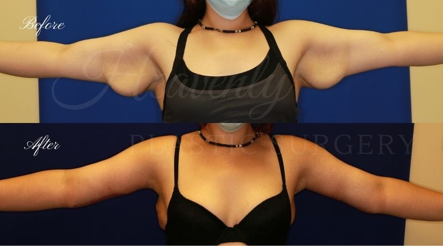 Plastic Surgery, plastic surgeon, mommy makeover, arm lift, abdominoplasty, brachioplasty, extra skin