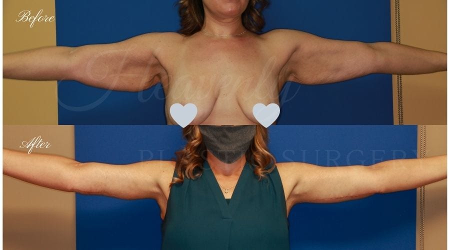 Plastic Surgery, Liposuction, Arm Lift, Brachioplasty, arms, bat wings