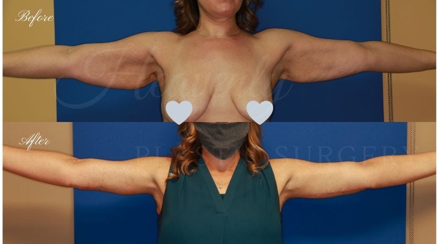 Plastic Surgery, Liposuction, Arm Lift, Brachioplasty, arms, bat wings Plastic Surgery, Liposuction, Arm Lift, Brachioplasty, arms, bat wings