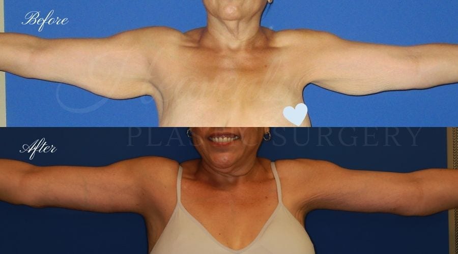 before and after image of a patient in her 50's who had an arm lift / brachioplasty performed by arm lift expert and plastic surgeon Dr. David Nguyen (front view)