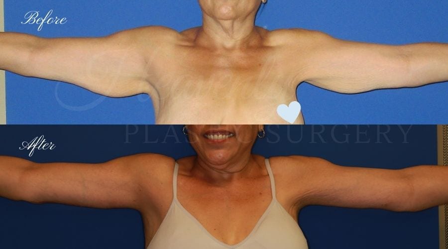 before and after image of a patient in her 50's who had an arm lift / brachioplasty performed by arm lift expert and plastic surgeon Dr. David Nguyen (front view) before and after image of a patient in her 50's who had an arm lift / brachioplasty performed by arm lift expert and plastic surgeon Dr. David Nguyen (front view)