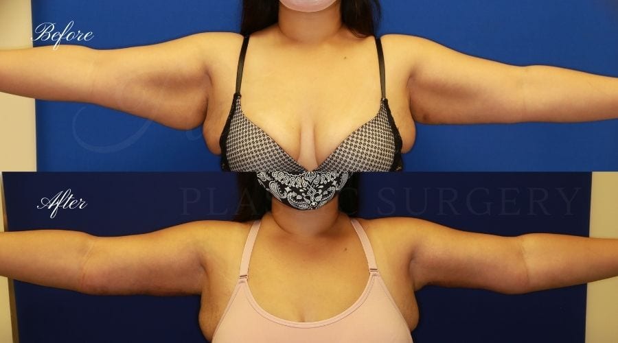 Plastic Surgery, plastic surgeon, arm lift, brachioplasty