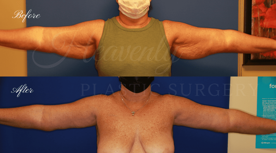 Plastic Surgery, plastic surgeon, mommy makeover, arm lift, abdominoplasty, brachioplasty, extra skin