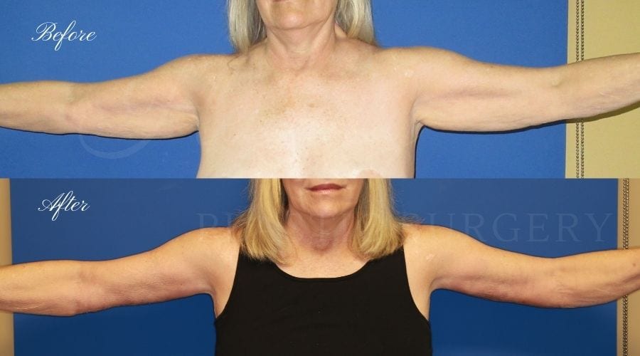 Plastic Surgery, plastic surgeon, arm lift, brachioplasty Plastic Surgery, plastic surgeon, arm lift, brachioplasty
