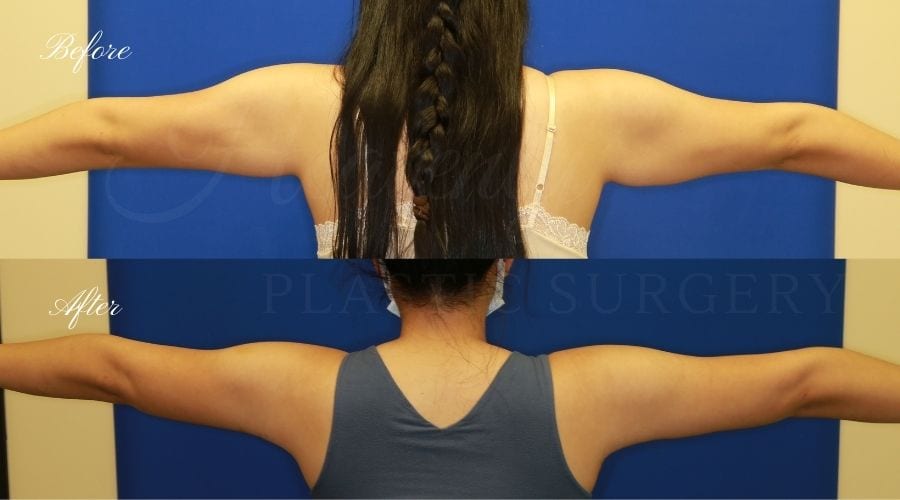 Plastic Surgery, plastic surgeon, arm lift, brachioplasty Plastic Surgery, plastic surgeon, arm lift, brachioplasty