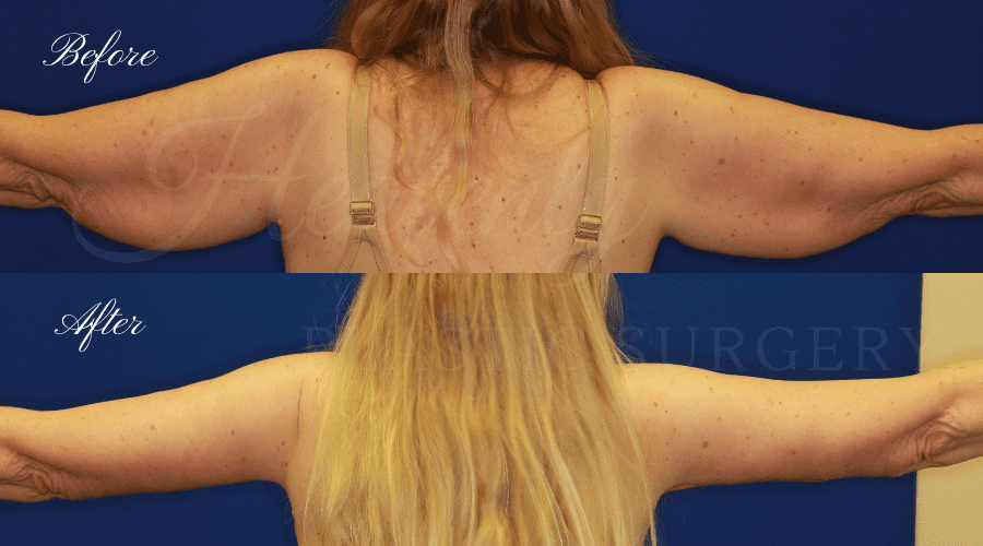 arm lift, extra arm skin, flabby arms, brachioplasty, before and after arm lift, plastic surgery, plastic surgeon, arm lift specialist, arm lift expert