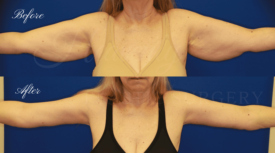 arm lift, extra arm skin, flabby arms, brachioplasty, before and after arm lift, plastic surgery, plastic surgeon, arm lift specialist, arm lift expert