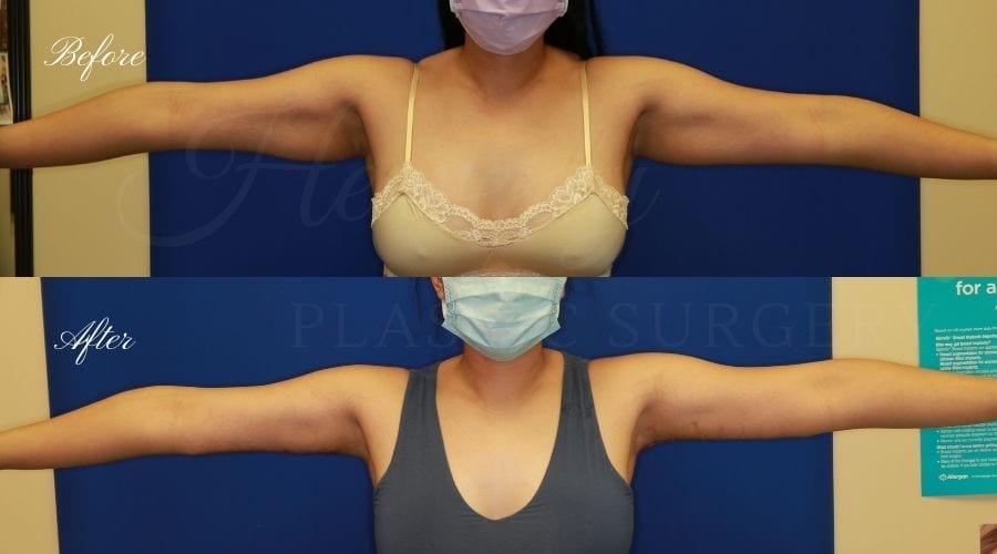 Plastic Surgery, plastic surgeon, arm lift, brachioplasty