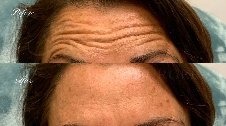 plastic surgery, plastic surgeon, botox, liquid facelift, forehead, forehead wrinkles, forehead lines, forehead lines, crows feet, fine lines, wrinkles, glabella, brows, jeuveau plastic surgery, plastic surgeon, botox, liquid facelift, forehead, forehead wrinkles, forehead lines, forehead lines, crows feet, fine lines, wrinkles, glabella, brows, jeuveau