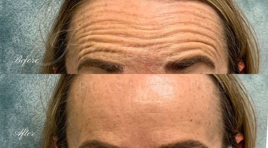 plastic surgery, plastic surgeon, botox, liquid facelift, forehead, forehead wrinkles, forehead lines, forehead lines, crows feet, fine lines, wrinkles, glabella, brows, jeuveau plastic surgery, plastic surgeon, botox, liquid facelift, forehead, forehead wrinkles, forehead lines, forehead lines, crows feet, fine lines, wrinkles, glabella, brows, jeuveau