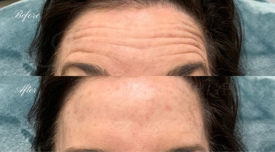 plastic surgery, plastic surgeon, botox, liquid facelift, forehead, forehead wrinkles, forehead lines, forehead lines, crows feet, fine lines, wrinkles, glabella, brows, jeuveau plastic surgery, plastic surgeon, botox, liquid facelift, forehead, forehead wrinkles, forehead lines, forehead lines, crows feet, fine lines, wrinkles, glabella, brows, jeuveau