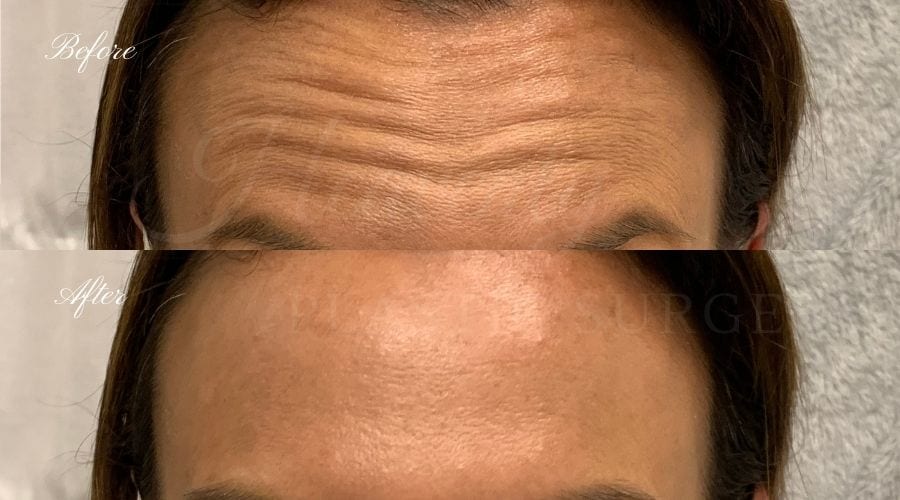 plastic surgery, plastic surgeon, botox, liquid facelift, forehead, forehead wrinkles, forehead lines, forehead lines, crows feet, fine lines, wrinkles, glabella, brows, jeuveau plastic surgery, plastic surgeon, botox, liquid facelift, forehead, forehead wrinkles, forehead lines, forehead lines, crows feet, fine lines, wrinkles, glabella, brows, jeuveau