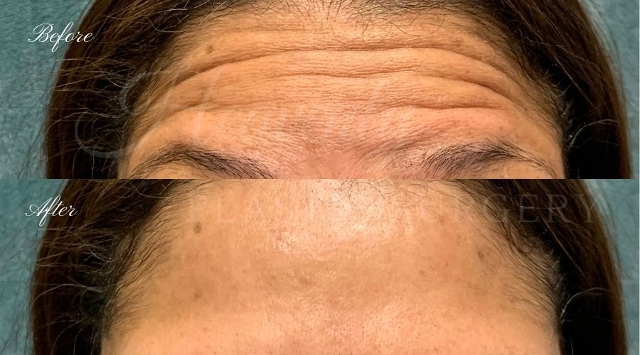 Plastic Surgery, Plastic Surgeon, Botox, Jeuveau, Forehead Wrinkles, Forehead, Injectables, Glabella, Crows Feet, Wifi, Wrinkles, Wrinkle Injection Plastic Surgery, Plastic Surgeon, Botox, Jeuveau, Forehead Wrinkles, Forehead, Injectables, Glabella, Crows Feet, Wifi, Wrinkles, Wrinkle Injection