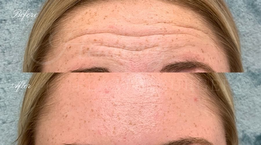 Plastic Surgery, Plastic Surgeon, Botox, Jeuveau, Forehead Wrinkles, Forehead, Injectables, Glabella, Crows Feet, Wifi, Wrinkles, Wrinkle Injection Plastic Surgery, Plastic Surgeon, Botox, Jeuveau, Forehead Wrinkles, Forehead, Injectables, Glabella, Crows Feet, Wifi, Wrinkles, Wrinkle Injection