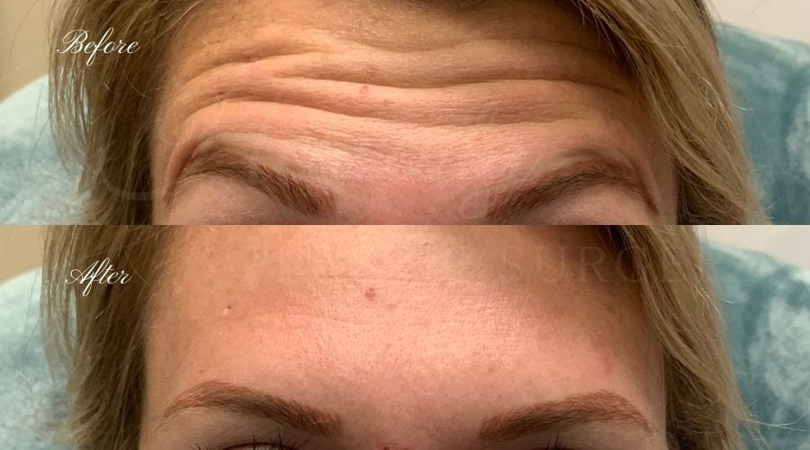 plastic surgery, plastic surgeon, botox, liquid facelift, forehead, forehead wrinkles, forehead lines, forehead lines, crows feet, fine lines, wrinkles, glabella, brows, jeuveau plastic surgery, plastic surgeon, botox, liquid facelift, forehead, forehead wrinkles, forehead lines, forehead lines, crows feet, fine lines, wrinkles, glabella, brows, jeuveau