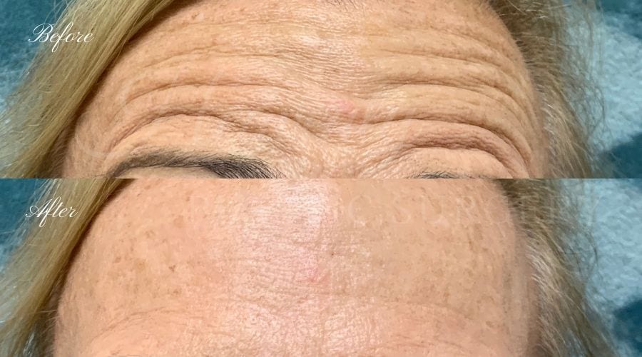 Plastic Surgery, Plastic Surgeon, Botox, Jeuveau, Forehead Wrinkles, Forehead, Injectables, Glabella, Crows Feet, Wifi, Wrinkles, Wrinkle Injection Plastic Surgery, Plastic Surgeon, Botox, Jeuveau, Forehead Wrinkles, Forehead, Injectables, Glabella, Crows Feet, Wifi, Wrinkles, Wrinkle Injection