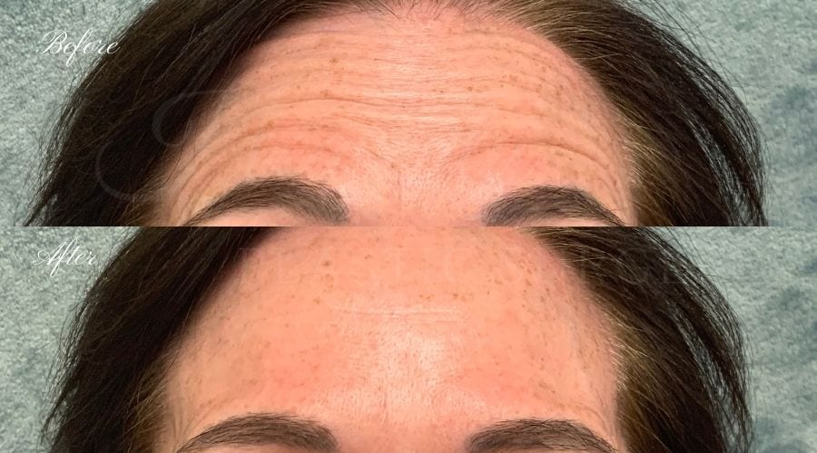 plastic surgery, plastic surgeon, botox, liquid facelift, forehead, forehead wrinkles, forehead lines, forehead lines, crows feet, fine lines, wrinkles, glabella, brows, jeuveau plastic surgery, plastic surgeon, botox, liquid facelift, forehead, forehead wrinkles, forehead lines, forehead lines, crows feet, fine lines, wrinkles, glabella, brows, jeuveau