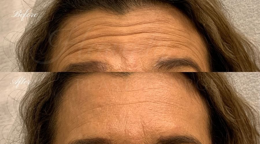plastic surgery, plastic surgeon, botox, liquid facelift, forehead, forehead wrinkles, forehead lines, forehead lines, crows feet, fine lines, wrinkles, glabella, brows, jeuveau plastic surgery, plastic surgeon, botox, liquid facelift, forehead, forehead wrinkles, forehead lines, forehead lines, crows feet, fine lines, wrinkles, glabella, brows, jeuveau