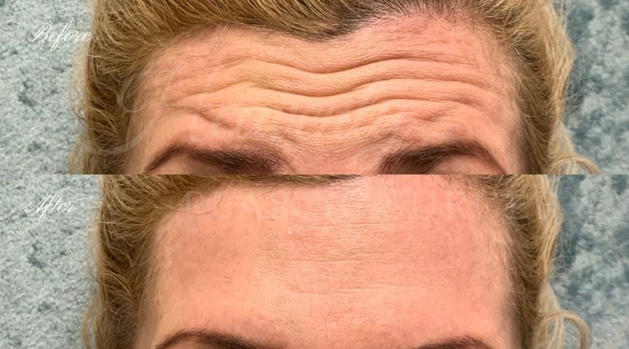 Plastic Surgery, Plastic Surgeon, Botox, Jeuveau, Forehead Wrinkles, Forehead, Injectables, Glabella, Crows Feet, Wifi, Wrinkles, Wrinkle Injection Plastic Surgery, Plastic Surgeon, Botox, Jeuveau, Forehead Wrinkles, Forehead, Injectables, Glabella, Crows Feet, Wifi, Wrinkles, Wrinkle Injection