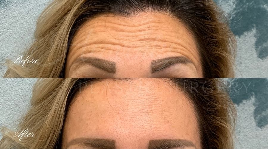plastic surgery, plastic surgeon, botox, liquid facelift, forehead, forehead wrinkles, forehead lines, forehead lines, crows feet, fine lines, wrinkles, glabella, brows, jeuveau plastic surgery, plastic surgeon, botox, liquid facelift, forehead, forehead wrinkles, forehead lines, forehead lines, crows feet, fine lines, wrinkles, glabella, brows, jeuveau