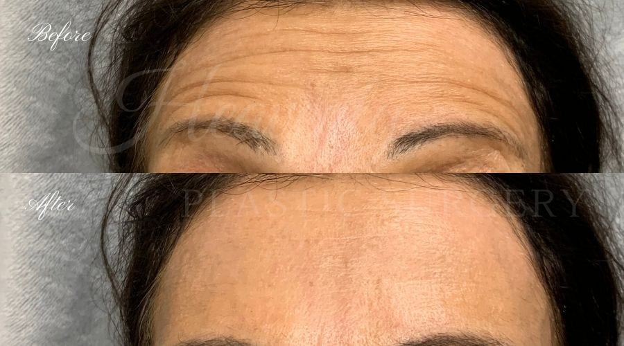 Plastic Surgery, Plastic Surgeon, Botox, Jeuveau, Forehead Wrinkles, Forehead, Injectables, Glabella, Crows Feet, Wifi, Wrinkles, Wrinkle Injection Plastic Surgery, Plastic Surgeon, Botox, Jeuveau, Forehead Wrinkles, Forehead, Injectables, Glabella, Crows Feet, Wifi, Wrinkles, Wrinkle Injection