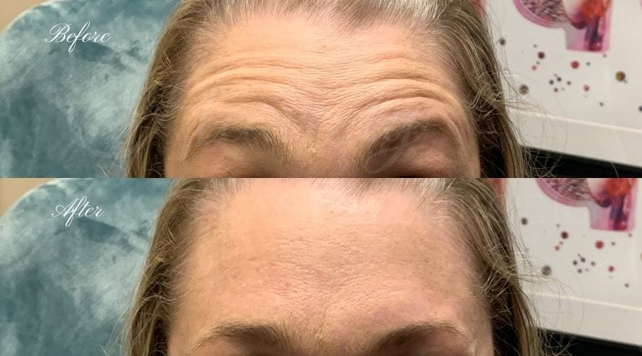 plastic surgery, plastic surgeon, botox, liquid facelift, forehead, forehead wrinkles, forehead lines, forehead lines, crows feet, fine lines, wrinkles, glabella, brows, jeuveau plastic surgery, plastic surgeon, botox, liquid facelift, forehead, forehead wrinkles, forehead lines, forehead lines, crows feet, fine lines, wrinkles, glabella, brows, jeuveau
