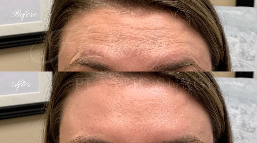 Plastic Surgery, Plastic Surgeon, Botox, Jeuveau, Forehead Wrinkles, Forehead, Injectables, Glabella, Crows Feet, Wifi, Wrinkles, Wrinkle Injection Plastic Surgery, Plastic Surgeon, Botox, Jeuveau, Forehead Wrinkles, Forehead, Injectables, Glabella, Crows Feet, Wifi, Wrinkles, Wrinkle Injection