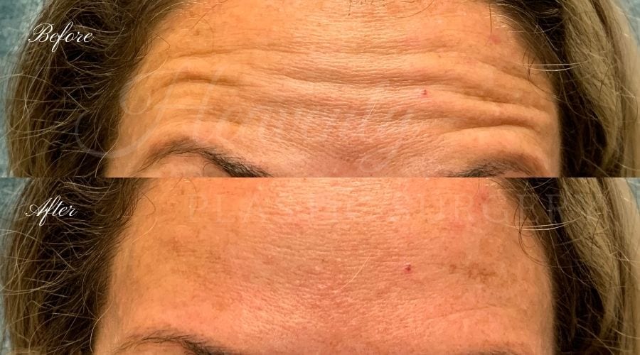 Plastic Surgery, Plastic Surgeon, Botox, Jeuveau, Forehead Wrinkles, Forehead, Injectables, Glabella, Crows Feet, Wifi, Wrinkles, Wrinkle Injection Plastic Surgery, Plastic Surgeon, Botox, Jeuveau, Forehead Wrinkles, Forehead, Injectables, Glabella, Crows Feet, Wifi, Wrinkles, Wrinkle Injection