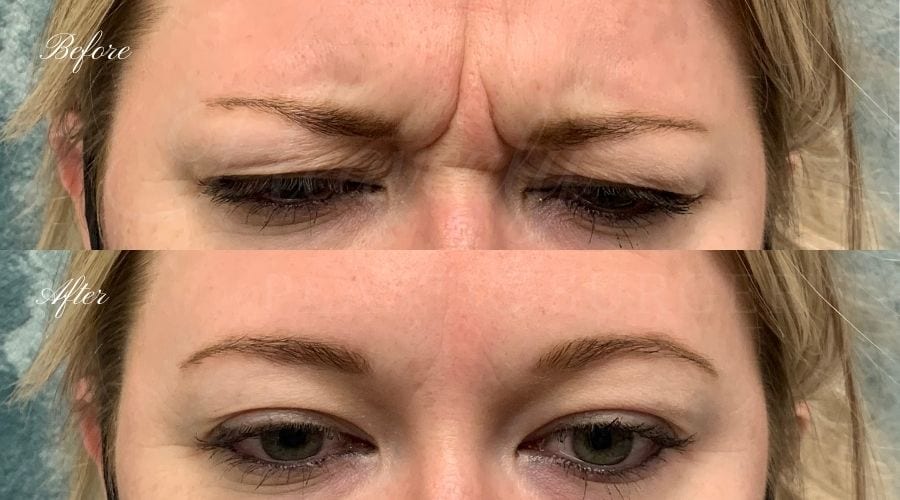 plastic surgery, plastic surgeon, botox, liquid facelift, forehead, forehead wrinkles, forehead lines, forehead lines, crows feet, fine lines, wrinkles, glabella, brows, jeuveau plastic surgery, plastic surgeon, botox, liquid facelift, forehead, forehead wrinkles, forehead lines, forehead lines, crows feet, fine lines, wrinkles, glabella, brows, jeuveau