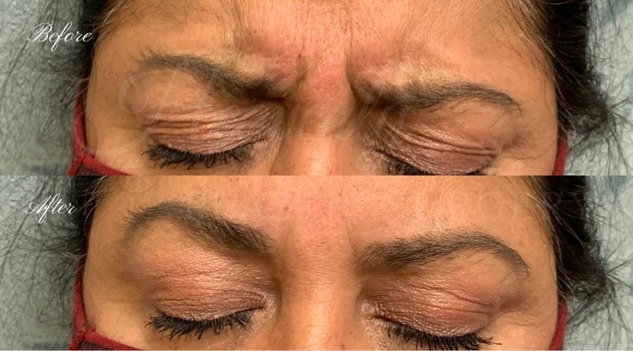 plastic surgery, plastic surgeon, botox, liquid facelift, forehead, forehead wrinkles, forehead lines, forehead lines, crows feet, fine lines, wrinkles, glabella, brows, jeuveau plastic surgery, plastic surgeon, botox, liquid facelift, forehead, forehead wrinkles, forehead lines, forehead lines, crows feet, fine lines, wrinkles, glabella, brows, jeuveau