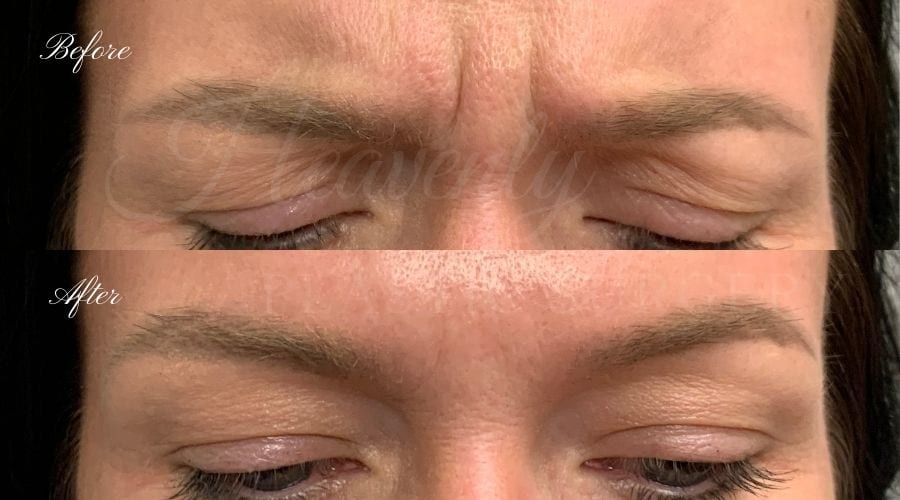 plastic surgery, plastic surgeon, botox, liquid facelift, forehead, forehead wrinkles, forehead lines, forehead lines, crows feet, fine lines, wrinkles, glabella, brows, jeuveau plastic surgery, plastic surgeon, botox, liquid facelift, forehead, forehead wrinkles, forehead lines, forehead lines, crows feet, fine lines, wrinkles, glabella, brows, jeuveau