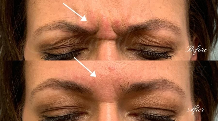 plastic surgery, plastic surgeon, botox, liquid facelift, forehead, forehead wrinkles, forehead lines, forehead lines, crows feet, fine lines, wrinkles, glabella, brows, jeuveau plastic surgery, plastic surgeon, botox, liquid facelift, forehead, forehead wrinkles, forehead lines, forehead lines, crows feet, fine lines, wrinkles, glabella, brows, jeuveau