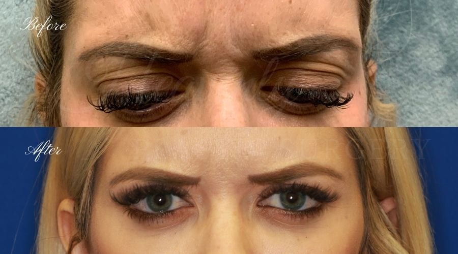 plastic surgery, plastic surgeon, botox, liquid facelift, forehead, forehead wrinkles, forehead lines, forehead lines, crows feet, fine lines, wrinkles, glabella, brows, jeuveau plastic surgery, plastic surgeon, botox, liquid facelift, forehead, forehead wrinkles, forehead lines, forehead lines, crows feet, fine lines, wrinkles, glabella, brows, jeuveau