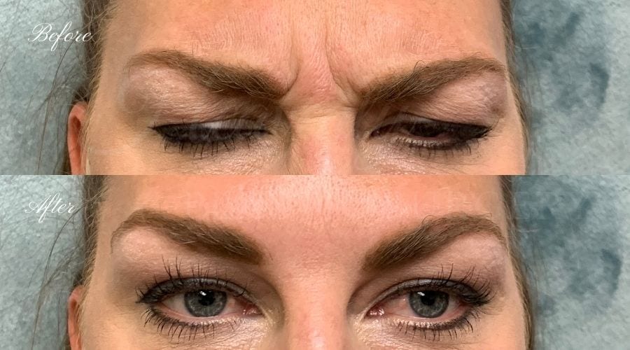 plastic surgery, plastic surgeon, botox, liquid facelift, forehead, forehead wrinkles, forehead lines, forehead lines, crows feet, fine lines, wrinkles, glabella, brows, jeuveau plastic surgery, plastic surgeon, botox, liquid facelift, forehead, forehead wrinkles, forehead lines, forehead lines, crows feet, fine lines, wrinkles, glabella, brows, jeuveau