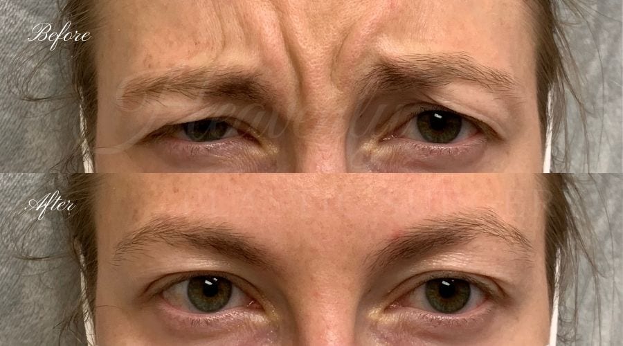 plastic surgery, plastic surgeon, botox, liquid facelift, forehead, forehead wrinkles, forehead lines, forehead lines, crows feet, fine lines, wrinkles, glabella, brows, jeuveau plastic surgery, plastic surgeon, botox, liquid facelift, forehead, forehead wrinkles, forehead lines, forehead lines, crows feet, fine lines, wrinkles, glabella, brows, jeuveau