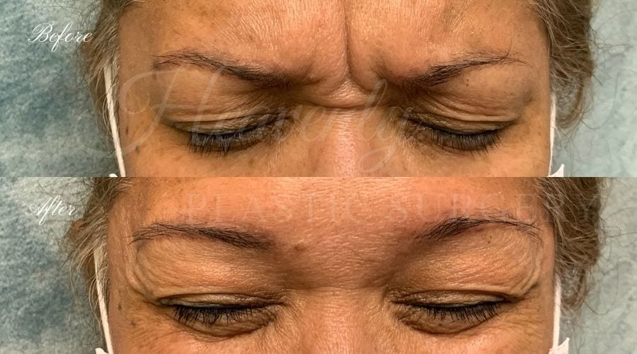 Plastic Surgery, Plastic Surgeon, Botox, Jeuveau, Forehead Wrinkles, Forehead, Injectables, Glabella, Crows Feet, Wifi, Wrinkles, Wrinkle Injection Plastic Surgery, Plastic Surgeon, Botox, Jeuveau, Forehead Wrinkles, Forehead, Injectables, Glabella, Crows Feet, Wifi, Wrinkles, Wrinkle Injection