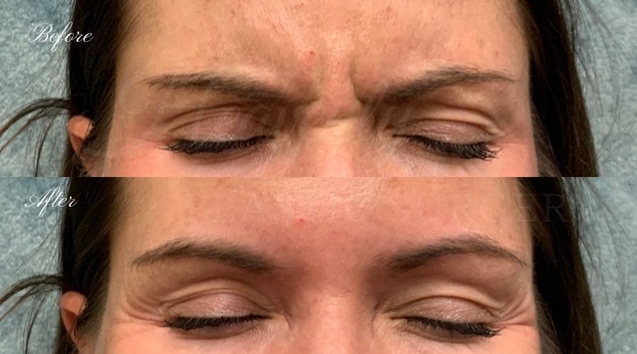 plastic surgery, plastic surgeon, botox, liquid facelift, forehead, forehead wrinkles, forehead lines, forehead lines, crows feet, fine lines, wrinkles, glabella, brows, jeuveau plastic surgery, plastic surgeon, botox, liquid facelift, forehead, forehead wrinkles, forehead lines, forehead lines, crows feet, fine lines, wrinkles, glabella, brows, jeuveau