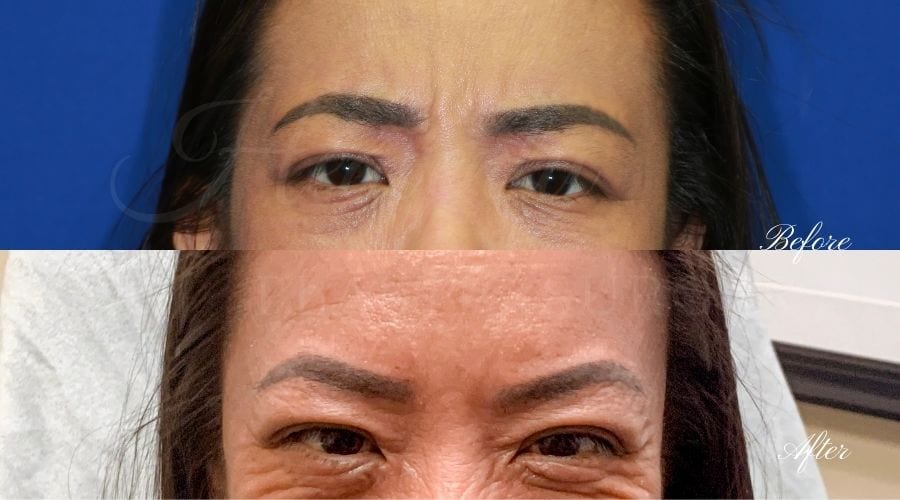 Plastic Surgery, Plastic Surgeon, Botox, Jeuveau, Forehead Wrinkles, Forehead, Injectables, Glabella, Crows Feet, Wifi, Wrinkles, Wrinkle Injection Plastic Surgery, Plastic Surgeon, Botox, Jeuveau, Forehead Wrinkles, Forehead, Injectables, Glabella, Crows Feet, Wifi, Wrinkles, Wrinkle Injection