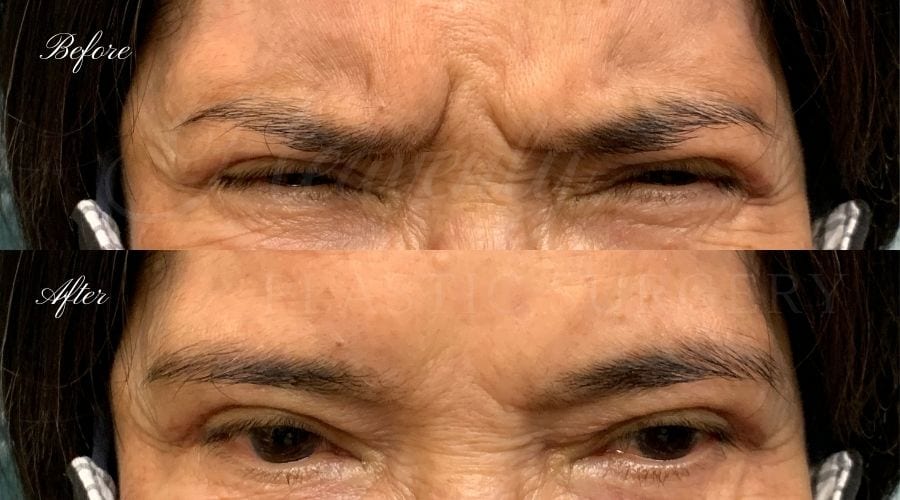 Plastic Surgery, Plastic Surgeon, Botox, Jeuveau, Forehead Wrinkles, Forehead, Injectables, Glabella, Crows Feet, Wifi, Wrinkles, Wrinkle Injection Plastic Surgery, Plastic Surgeon, Botox, Jeuveau, Forehead Wrinkles, Forehead, Injectables, Glabella, Crows Feet, Wifi, Wrinkles, Wrinkle Injection