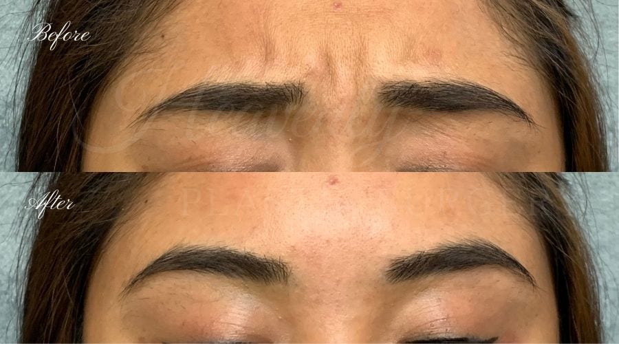 plastic surgery, plastic surgeon, botox, liquid facelift, forehead, forehead wrinkles, forehead lines, forehead lines, crows feet, fine lines, wrinkles, glabella, brows, jeuveau plastic surgery, plastic surgeon, botox, liquid facelift, forehead, forehead wrinkles, forehead lines, forehead lines, crows feet, fine lines, wrinkles, glabella, brows, jeuveau