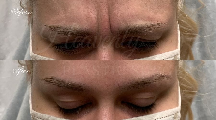 plastic surgery, plastic surgeon, botox, liquid facelift, forehead, forehead wrinkles, forehead lines, forehead lines, crows feet, fine lines, wrinkles, glabella, brows, jeuveau plastic surgery, plastic surgeon, botox, liquid facelift, forehead, forehead wrinkles, forehead lines, forehead lines, crows feet, fine lines, wrinkles, glabella, brows, jeuveau