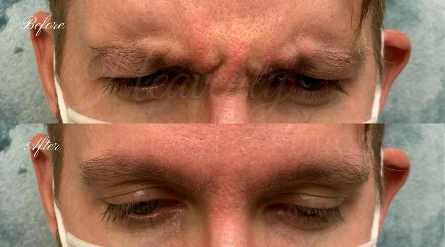 plastic surgery, plastic surgeon, botox, liquid facelift, forehead, forehead wrinkles, forehead lines, forehead lines, crows feet, fine lines, wrinkles, glabella, brows, jeuveau, male botox, brotox, botox for males, male botox orange county