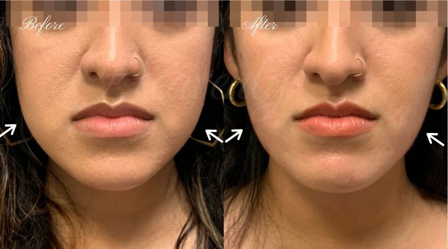 plastic surgery, plastic surgeon, botox, liquid facelift, masseters, masseter botox, jaw botox, masseter muscles plastic surgery, plastic surgeon, botox, liquid facelift, masseters, masseter botox, jaw botox, masseter muscles