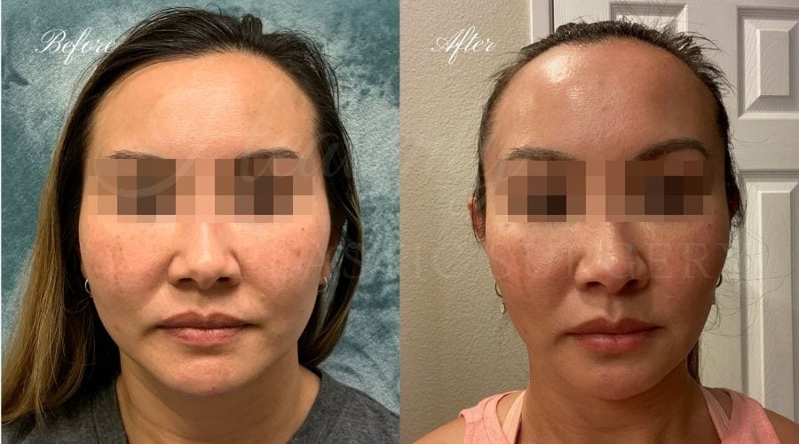 plastic surgery, plastic surgeon, botox, liquid facelift, masseters, masseter botox, jaw botox, masseter muscles plastic surgery, plastic surgeon, botox, liquid facelift, masseters, masseter botox, jaw botox, masseter muscles