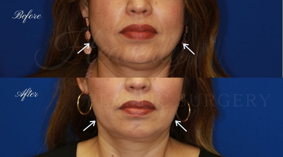 plastic surgery, plastic surgeon, botox, liquid facelift, masseters, masseter botox, jaw botox, masseter muscles plastic surgery, plastic surgeon, botox, liquid facelift, masseters, masseter botox, jaw botox, masseter muscles