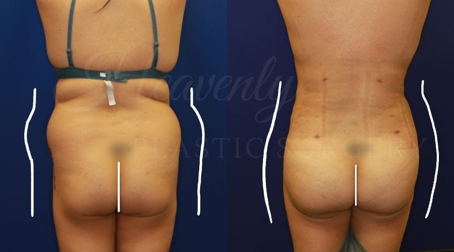 BBL, Brazilian Butt Lift, Brazilian Butt Lift Surgery, Butt Augmentation, Butt Augmentation Surgery, Liposuction, Lipo 360, Brazilian Butt LIft Before and After, Brazilian Butt Lift Results, Liposuction Results, Liposuction Before and After BBL, Brazilian Butt Lift, Brazilian Butt Lift Surgery, Butt Augmentation, Butt Augmentation Surgery, Liposuction, Lipo 360, Brazilian Butt LIft Before and After, Brazilian Butt Lift Results, Liposuction Results, Liposuction Before and After