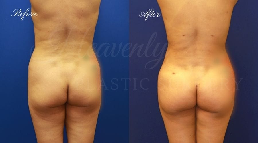 BBL Orange county, brazilian butt lift orange county, brazilian butt lift before and after, brazilian butt lift surgeon, brazilian butt lift results, bbl surgeon, bbl results, bbl before and after, fat transfer to the butt, butt augmentation, butt augmentation surgery, butt augmentation surgeon